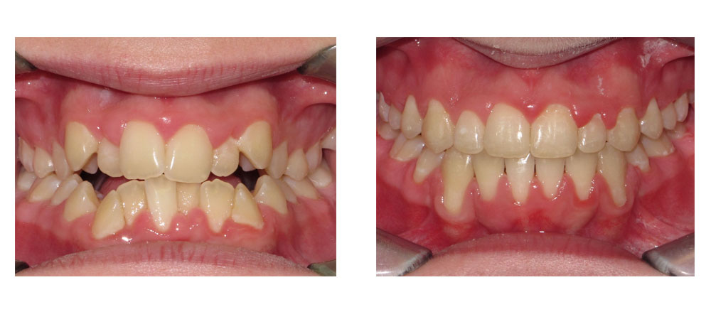 Deep Overbite Before And After  Braces before and after, Misaligned teeth,  After braces